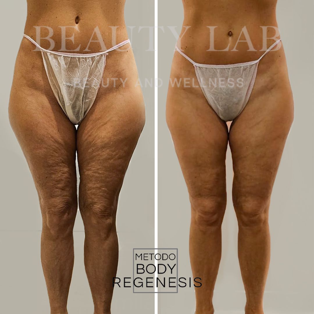 Prima e dopo Body Regenesis®: cosce e ritenzione idrica