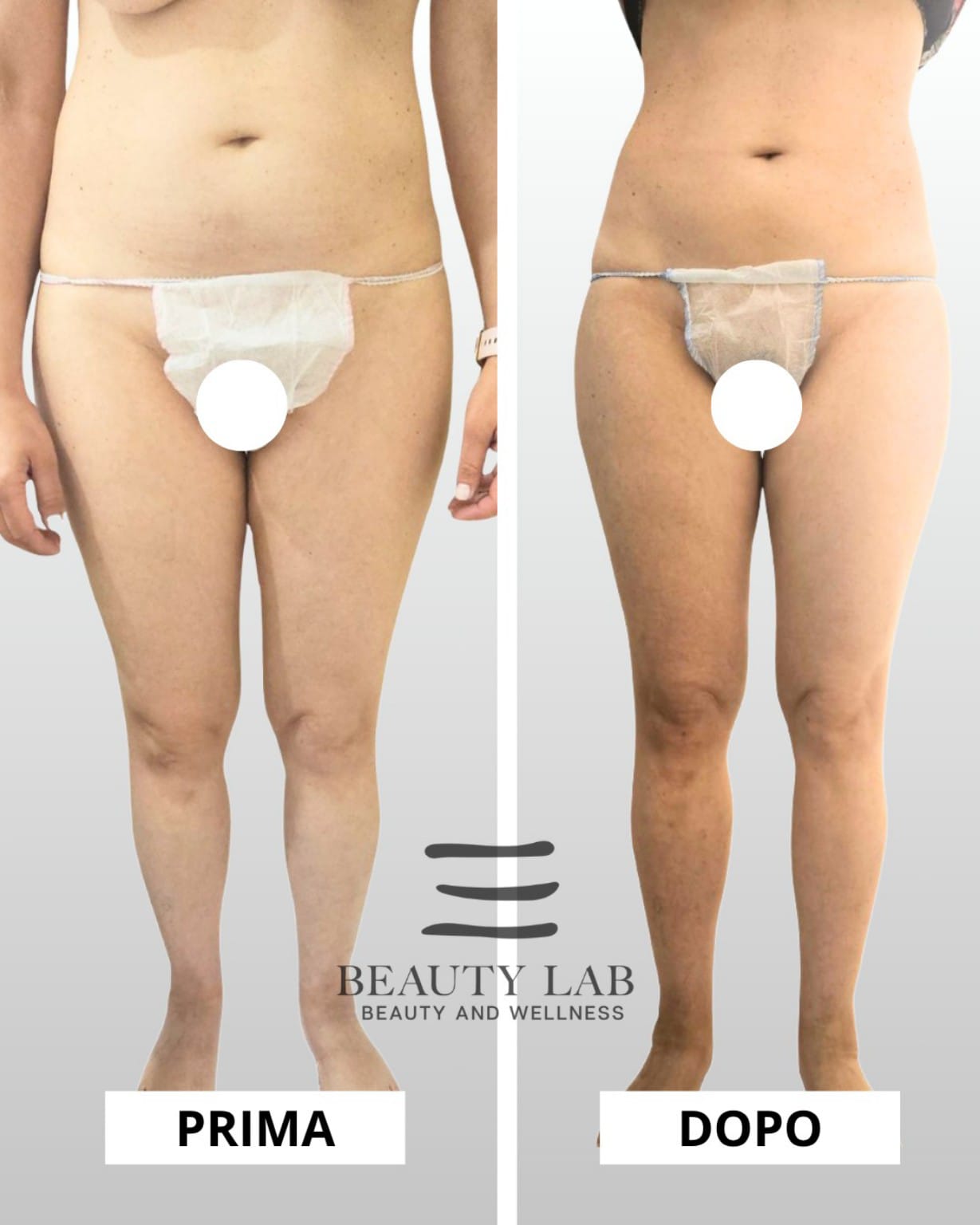 Prima e dopo Body Regenesis®: silhouette completa