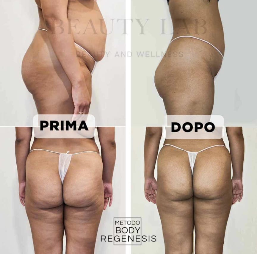 Prima e dopo Body Regenesis®: compattezza cutanea e cellulite