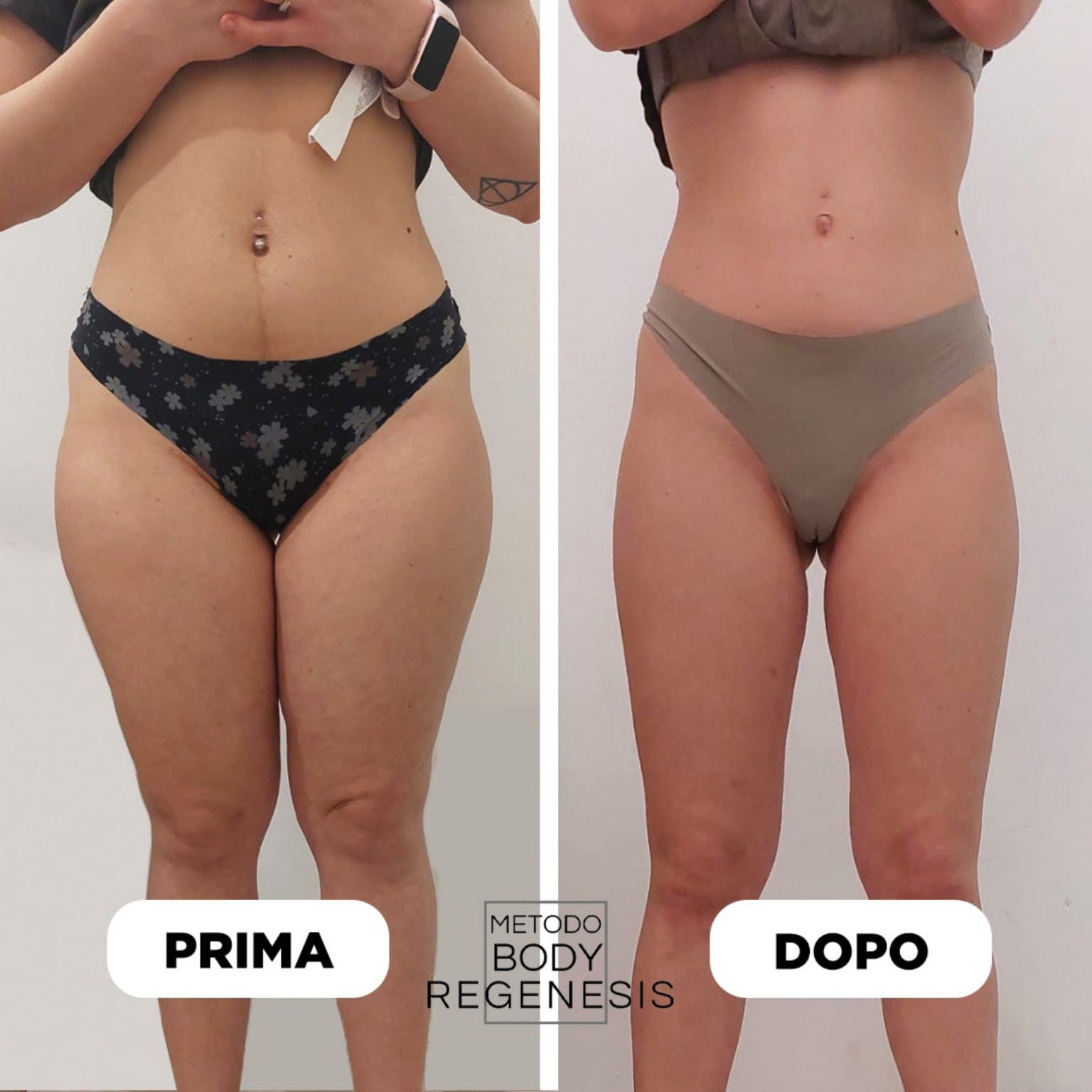 Prima e dopo Body Regenesis®: addome, fianchi e cosce