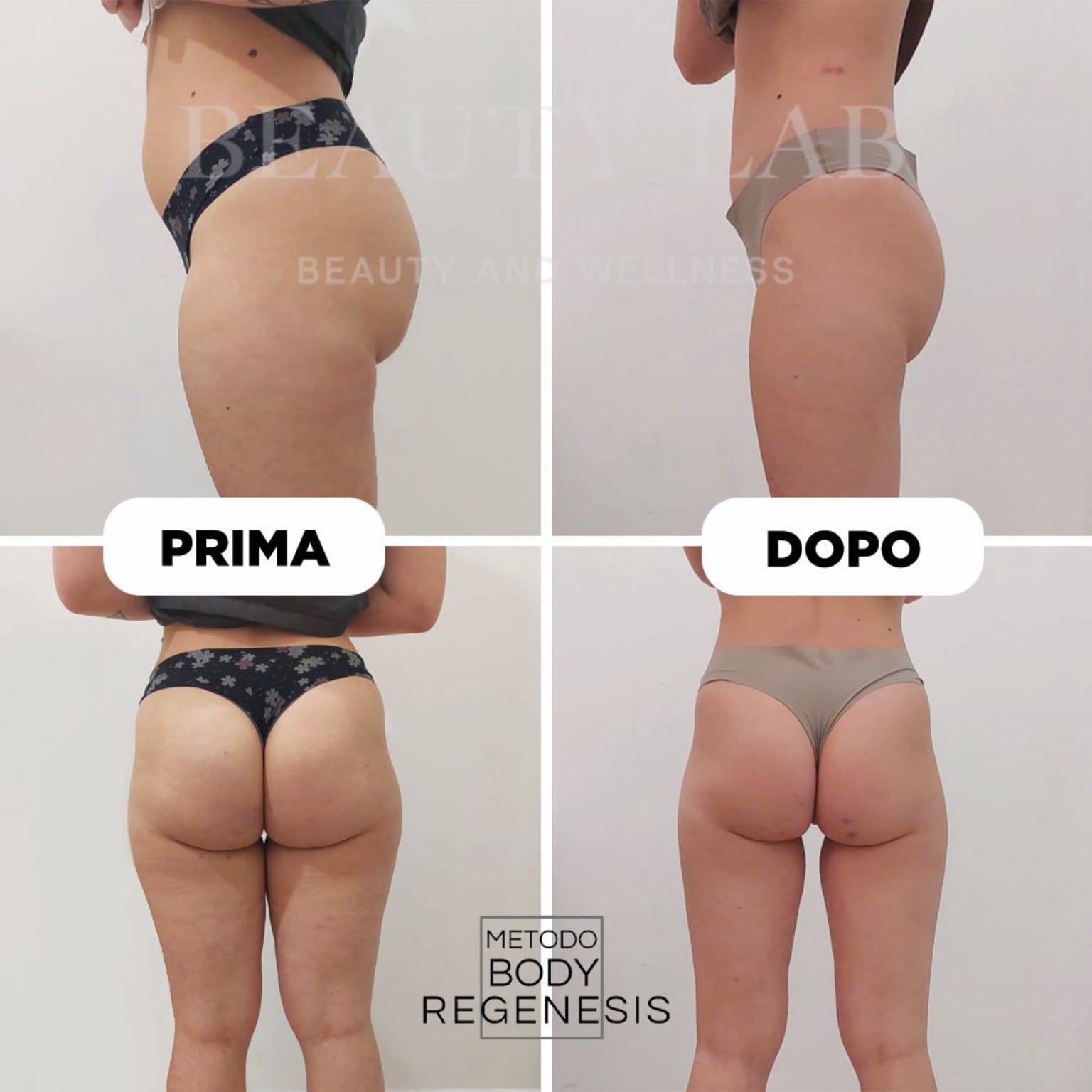 Prima e dopo Body Regenesis®: glutei e profilo laterale