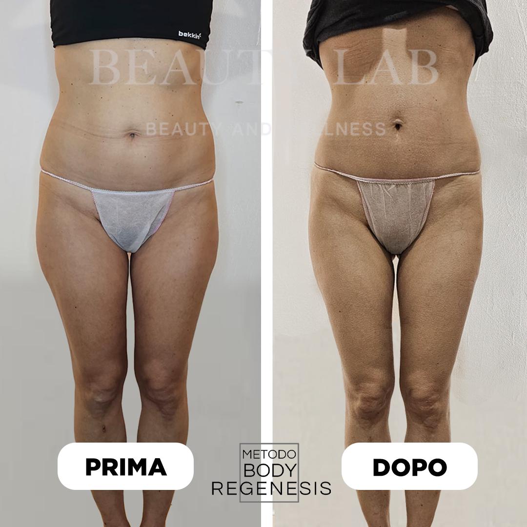 Prima e dopo Body Regenesis®: addome e gambe